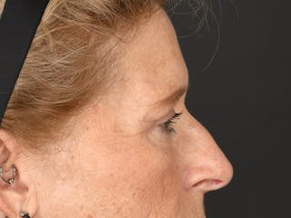 Blepharoplasty Before & After Gallery - Patient 141049 - Image 8