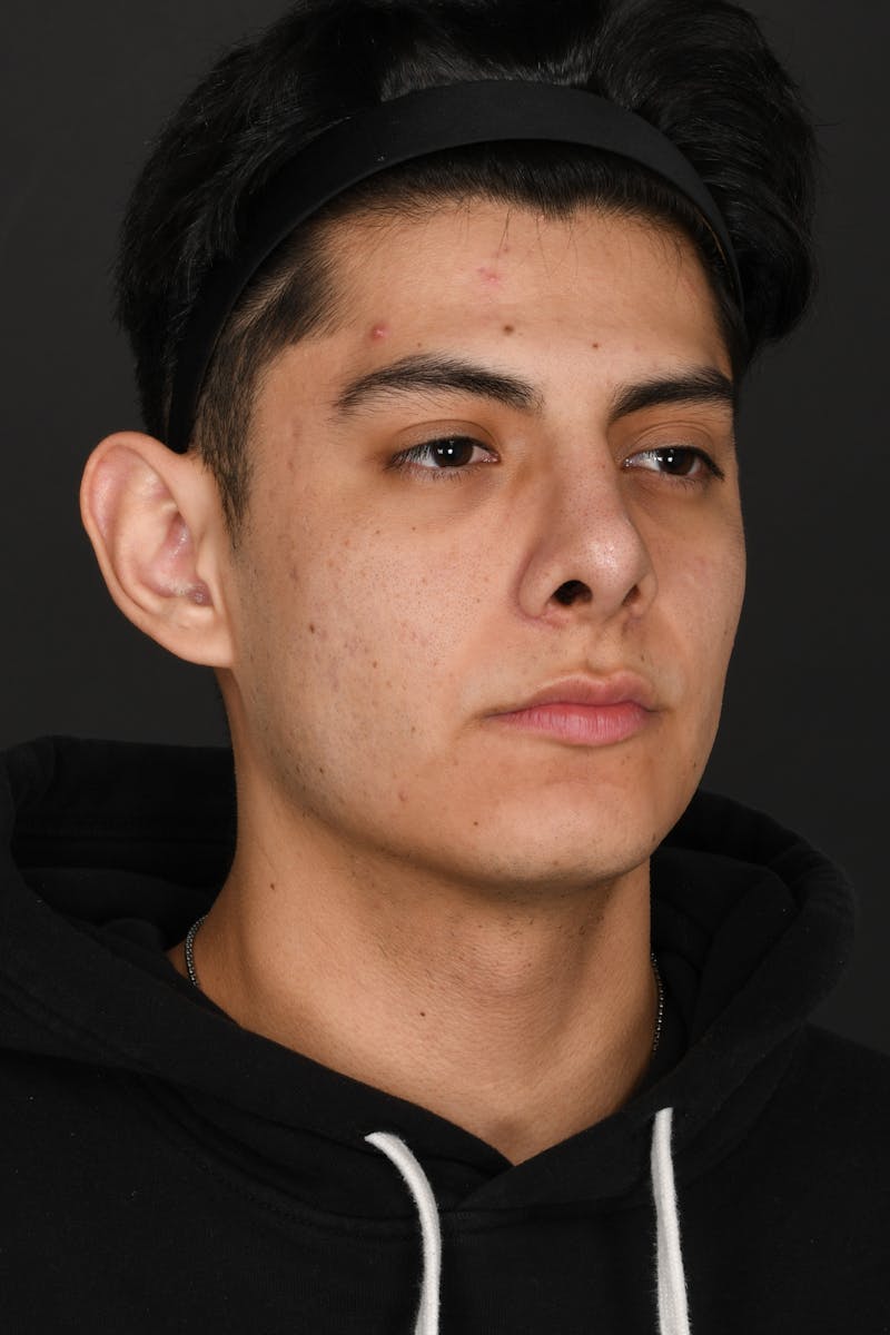 Rhinoplasty Before & After Gallery - Patient 321101 - Image 8