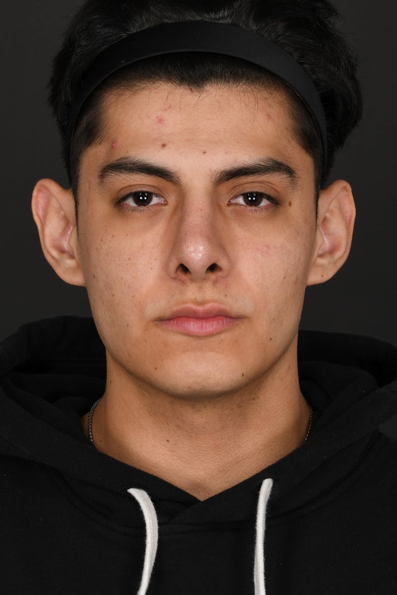 Rhinoplasty Before & After Gallery - Patient 321101 - Image 6