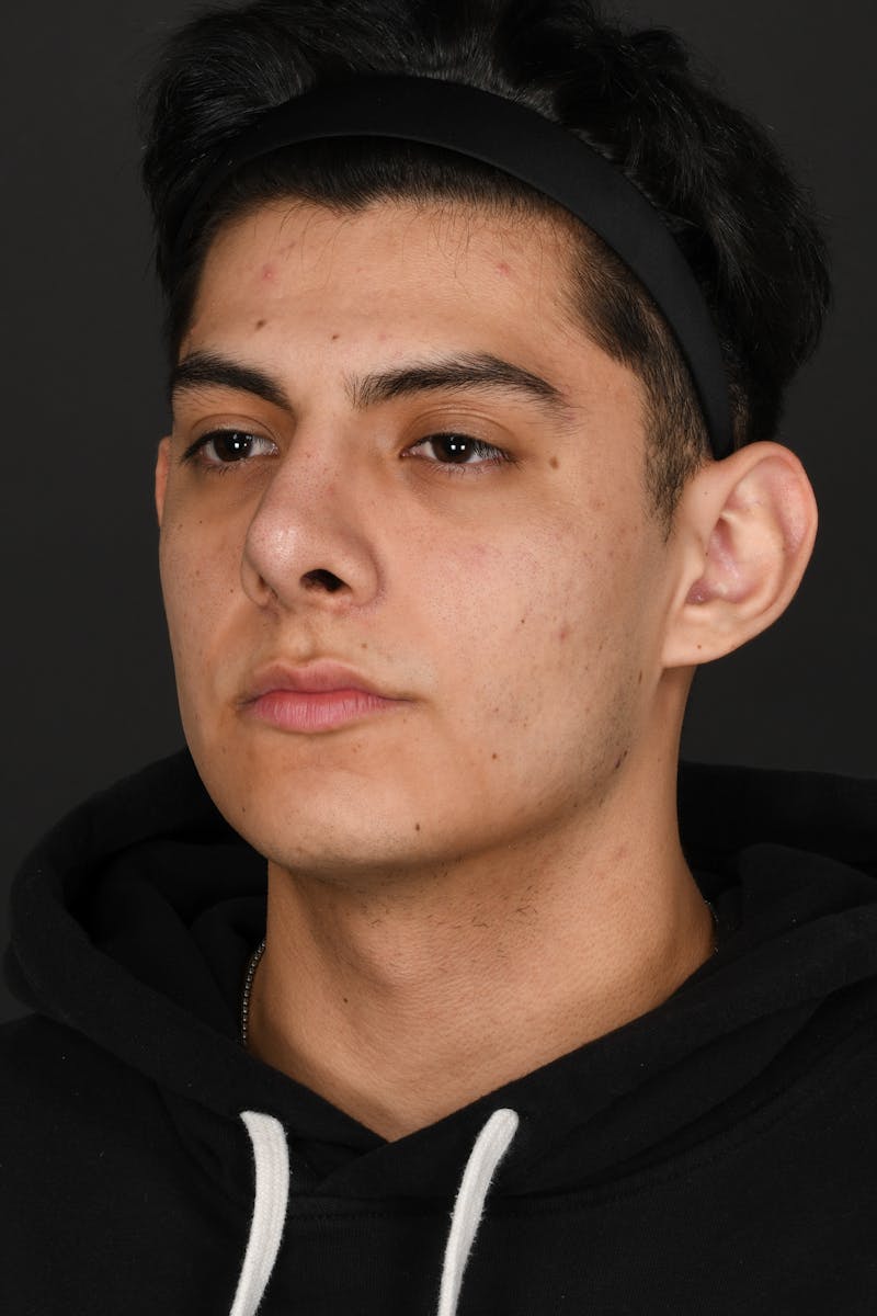 Rhinoplasty Before & After Gallery - Patient 321101 - Image 12