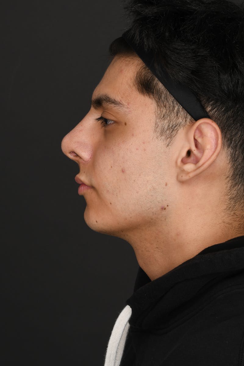 Rhinoplasty Before & After Gallery - Patient 321101 - Image 12
