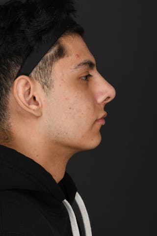 Rhinoplasty Before & After Gallery - Patient 321101 - Image 8