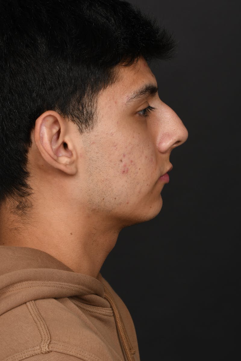 Rhinoplasty Before & After Gallery - Patient 321101 - Image 9