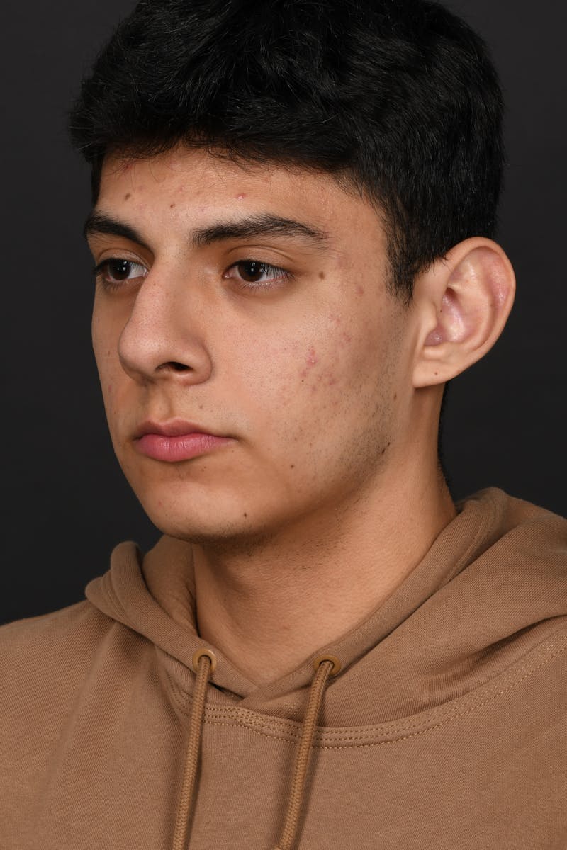 Rhinoplasty Before & After Gallery - Patient 321101 - Image 11