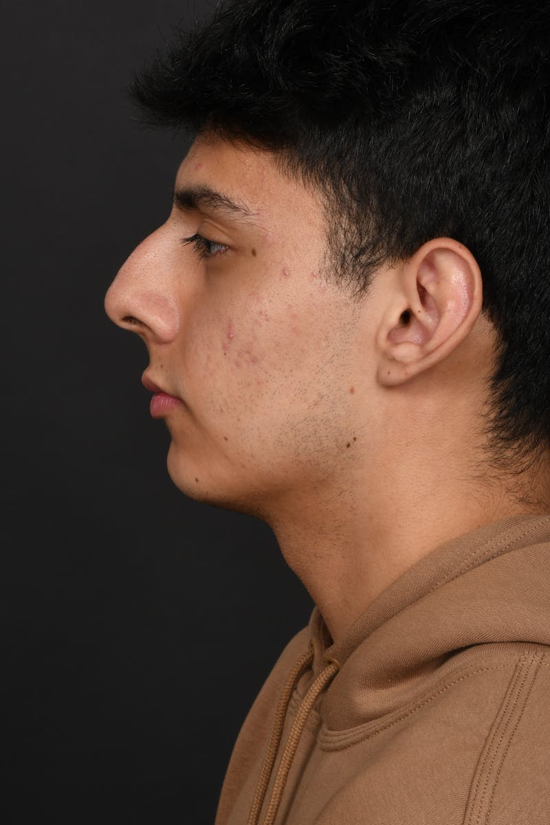Rhinoplasty Before & After Gallery - Patient 321101 - Image 11