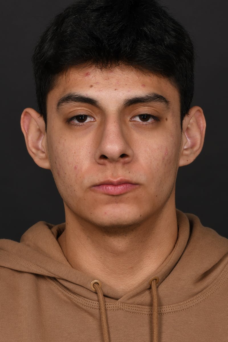 Rhinoplasty Before & After Gallery - Patient 321101 - Image 5