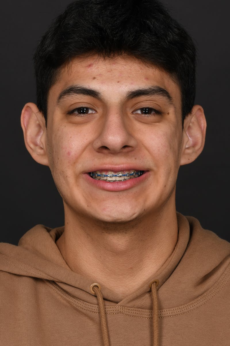 Rhinoplasty Before & After Gallery - Patient 321101 - Image 3