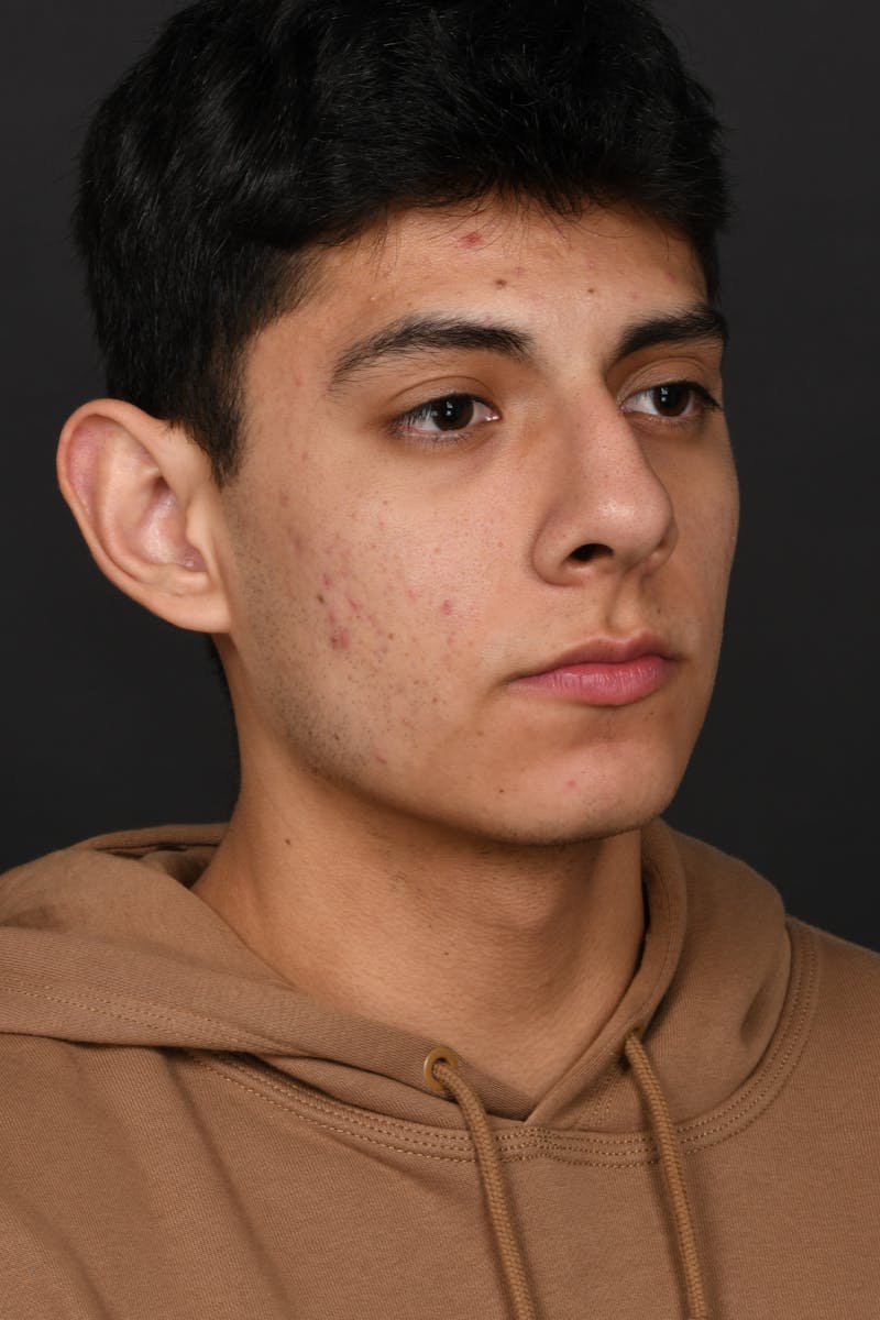 Rhinoplasty Before & After Gallery - Patient 321101 - Image 7