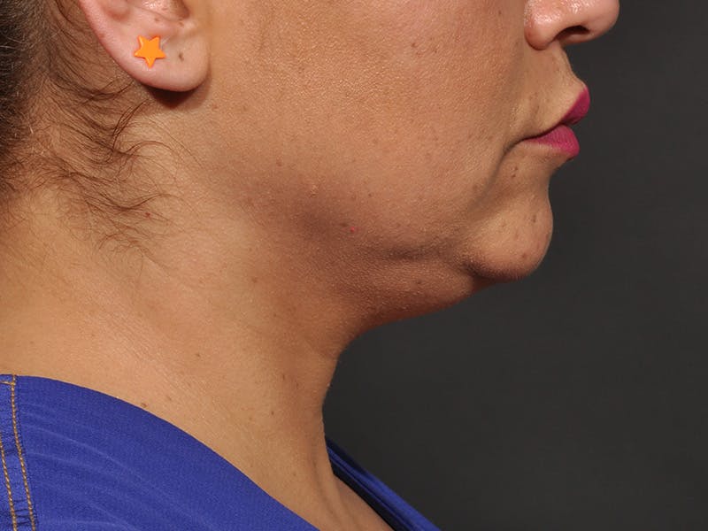 Neck Lift Before & After Gallery - Patient 140149 - Image 3