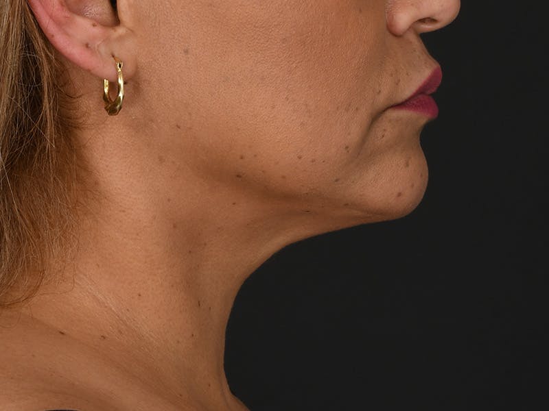 Neck Lift Before & After Gallery - Patient 140149 - Image 4