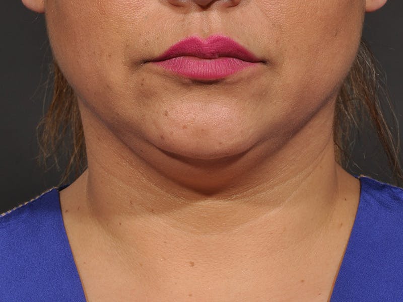 Neck Lift Before & After Gallery - Patient 140149 - Image 5