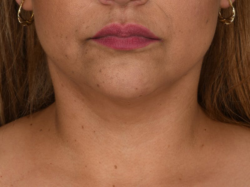 Neck Lift Before & After Gallery - Patient 140149 - Image 6