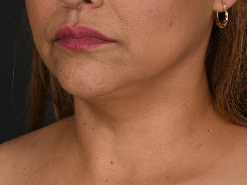 Neck Lift Before & After Gallery - Patient 140149 - Image 8