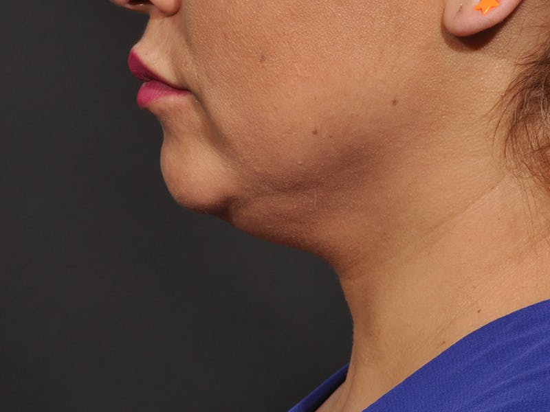Neck Lift Before & After Gallery - Patient 140149 - Image 9
