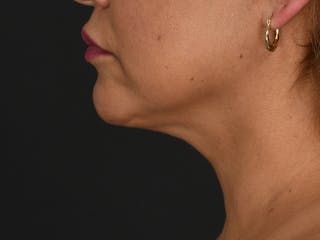 Neck Lift Before & After Gallery - Patient 140149 - Image 10