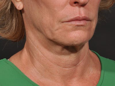 Neck Lift Before & After Gallery - Patient 528224 - Image 1