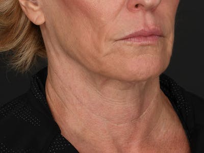 Neck Lift Before & After Gallery - Patient 528224 - Image 2