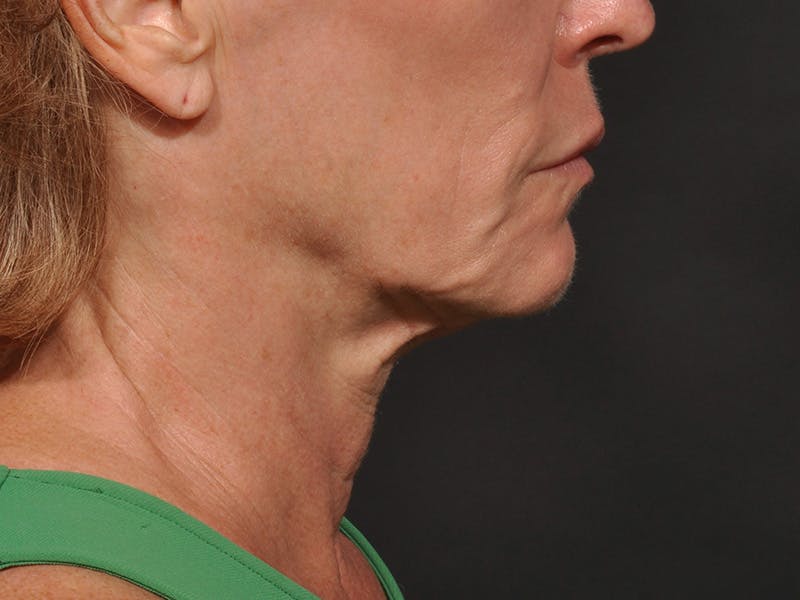 Neck Lift Before & After Gallery - Patient 528224 - Image 3