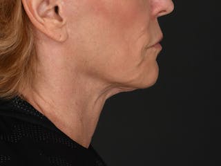 Neck Lift Before & After Gallery - Patient 528224 - Image 4