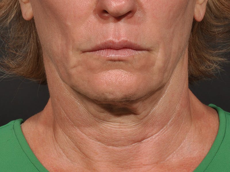 Neck Lift Before & After Gallery - Patient 528224 - Image 5
