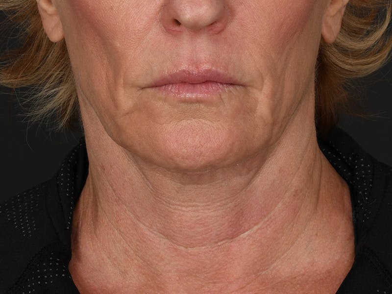 Neck Lift Before & After Gallery - Patient 528224 - Image 6