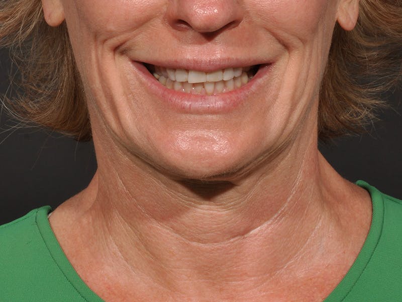 Neck Lift Before & After Gallery - Patient 528224 - Image 7