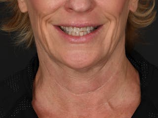 Neck Lift Before & After Gallery - Patient 528224 - Image 8