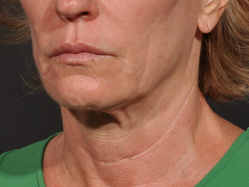 Neck Lift Before & After Gallery - Patient 528224 - Image 9
