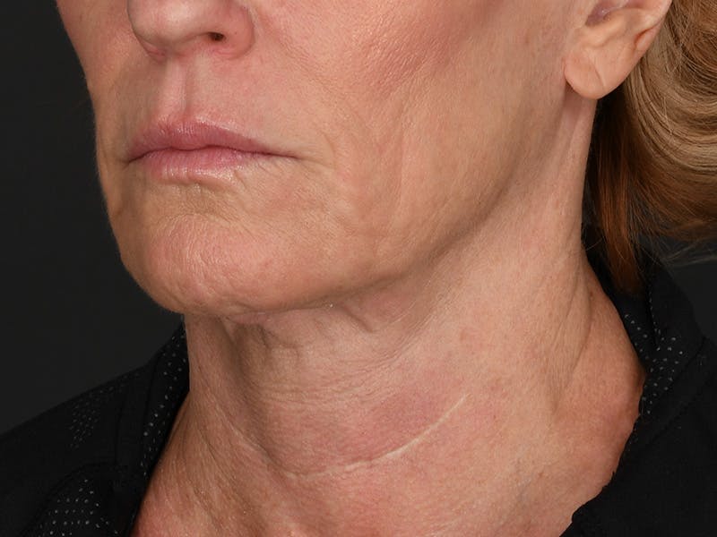 Neck Lift Before & After Gallery - Patient 528224 - Image 10