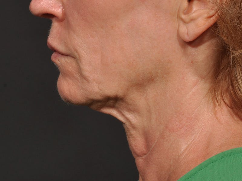 Neck Lift Before & After Gallery - Patient 528224 - Image 11