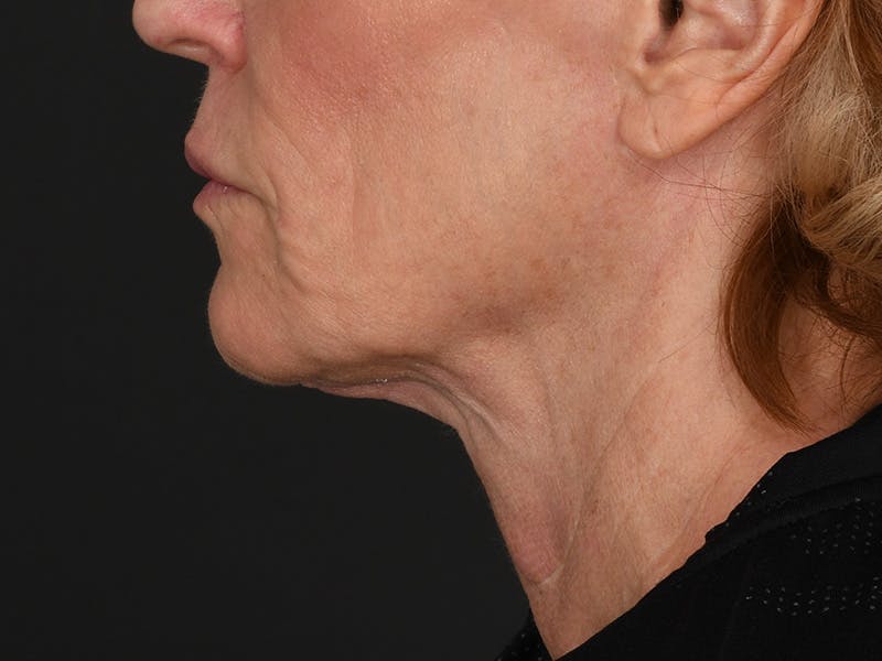 Neck Lift Before & After Gallery - Patient 528224 - Image 12