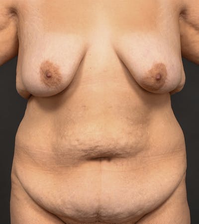 Mommy Makeover Before & After Gallery - Patient 140783 - Image 1