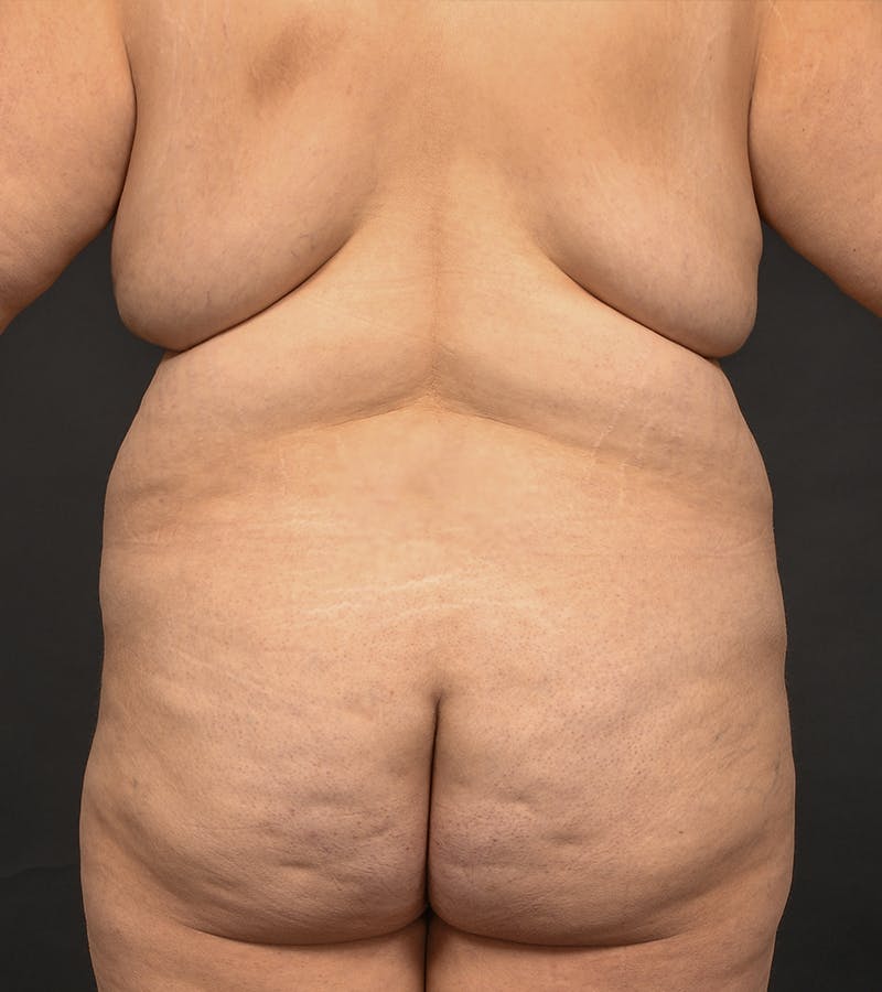 Mommy Makeover Before & After Gallery - Patient 140783 - Image 13