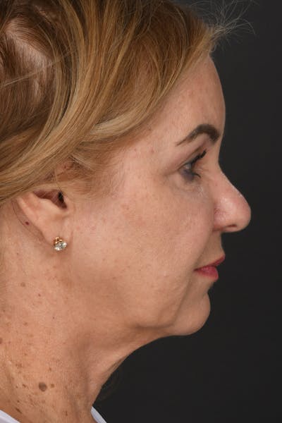Facelift Before & After Gallery - Patient 423845 - Image 1