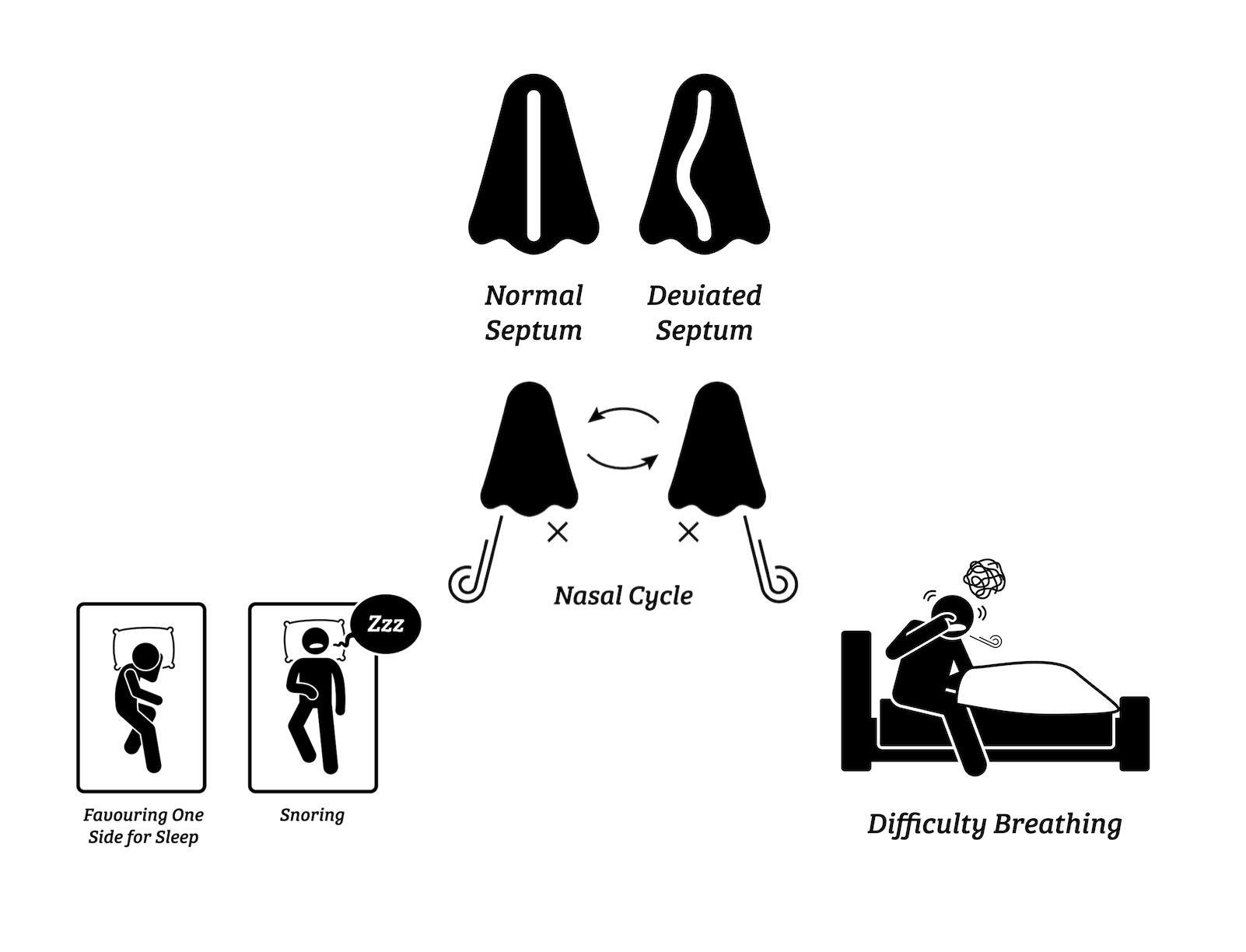 Deviated septum symptoms diagram