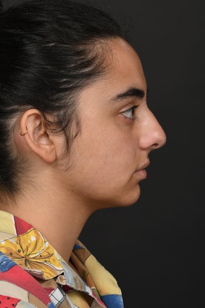 Rhinoplasty Before & After Gallery - Patient 393416 - Image 1
