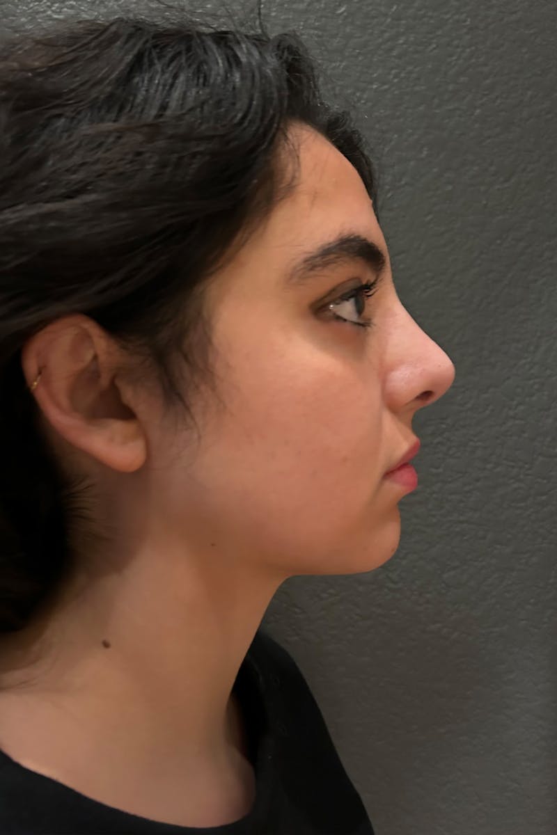 Rhinoplasty Before & After Gallery - Patient 393416 - Image 2