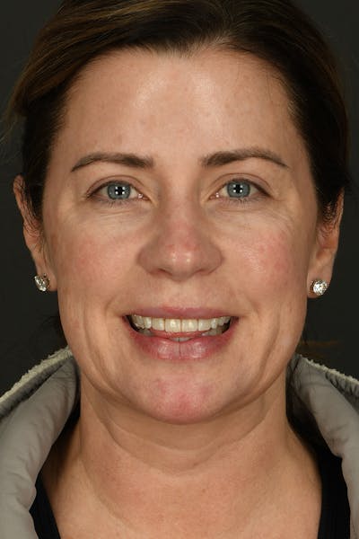 Facelift Before & After Gallery - Patient 594192 - Image 1