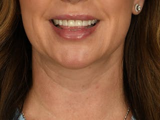 Neck Lift Before & After Gallery - Patient 343909 - Image 4