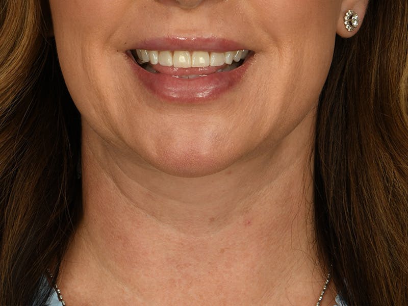 Neck Lift Before & After Gallery - Patient 343909 - Image 4