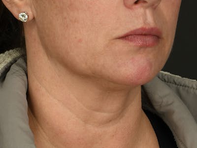 Neck Lift Before & After Gallery - Patient 343909 - Image 1