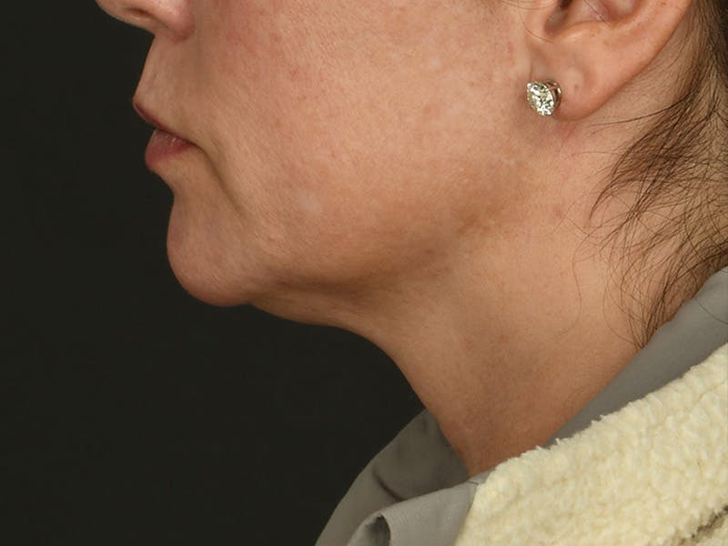Neck Lift Before & After Gallery - Patient 343909 - Image 5