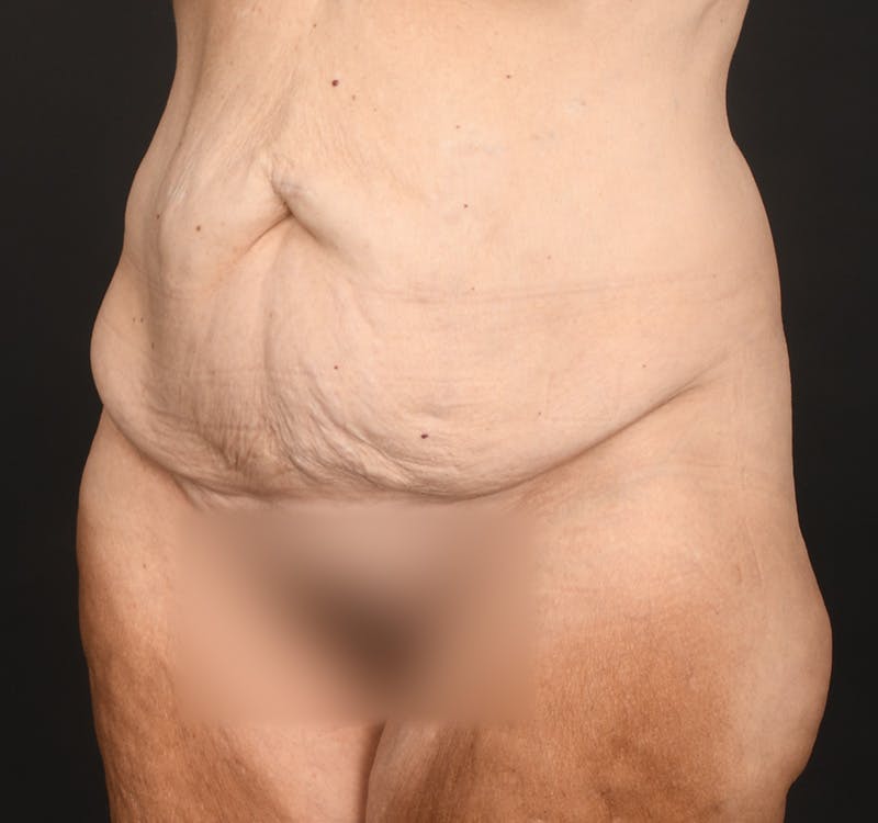 Tummy Tuck Before & After Gallery - Patient 286245 - Image 5