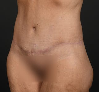 Tummy Tuck Before & After Gallery - Patient 286245 - Image 6