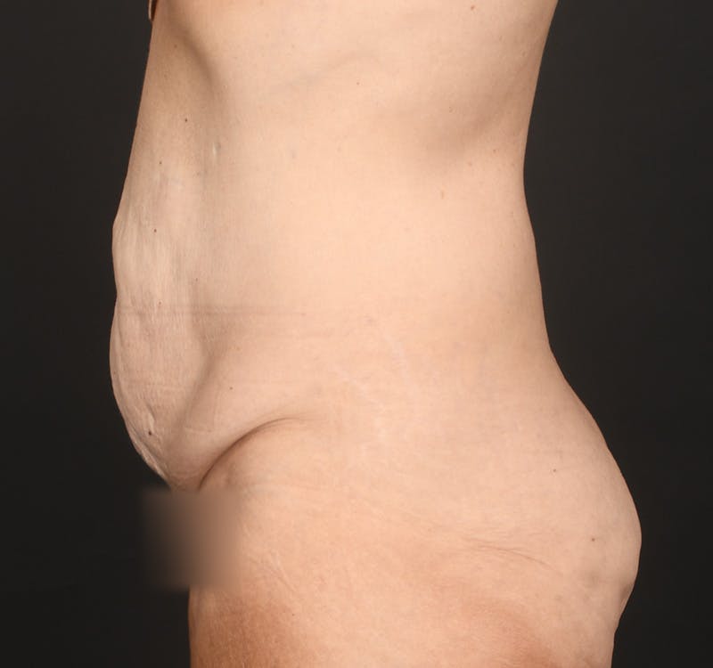 Tummy Tuck Before & After Gallery - Patient 286245 - Image 7