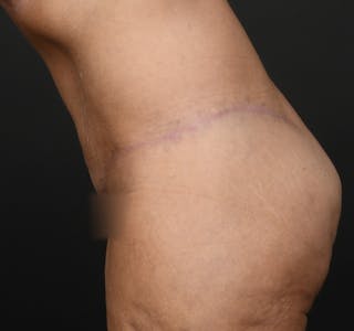 Tummy Tuck Before & After Gallery - Patient 286245 - Image 10