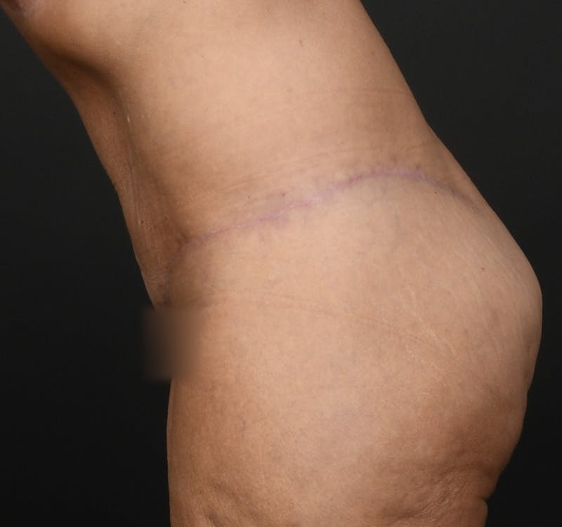 Tummy Tuck Before & After Gallery - Patient 286245 - Image 10