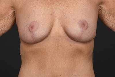 Breast Lift Before & After Gallery - Patient 288761 - Image 2