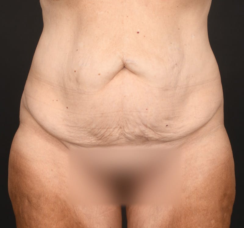 Tummy Tuck Before & After Gallery - Patient 286245 - Image 1