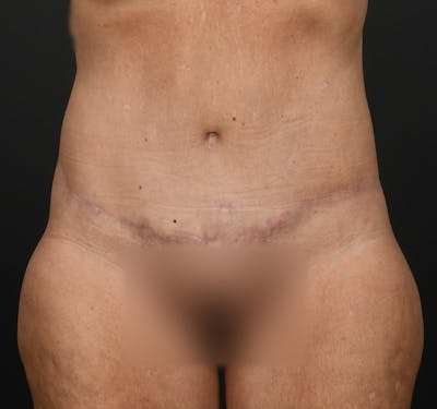 Tummy Tuck Before & After Gallery - Patient 286245 - Image 2
